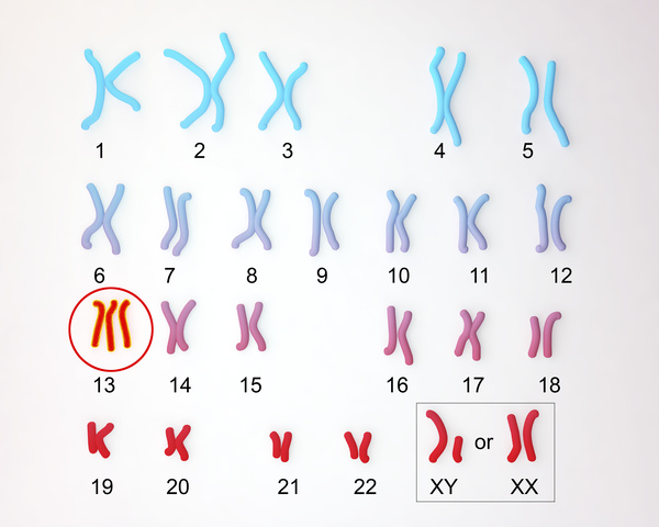 13トリソミーの染色体