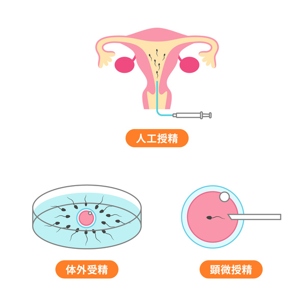 人工授精、体外受精、顕微授精