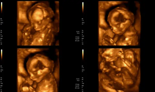妊娠3ヶ月の4Dエコー画像