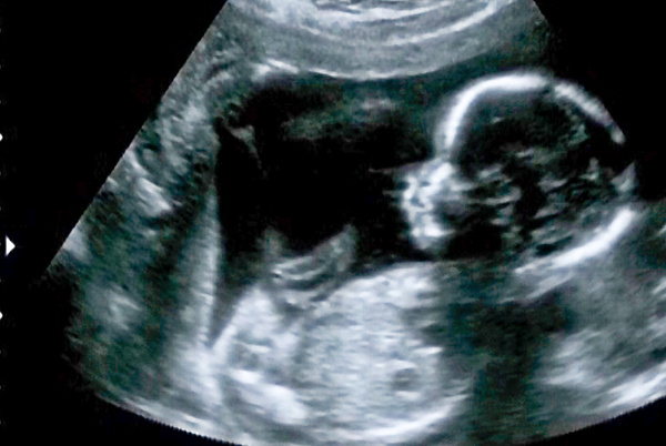 妊娠4ヶ月の胎児のエコー画像