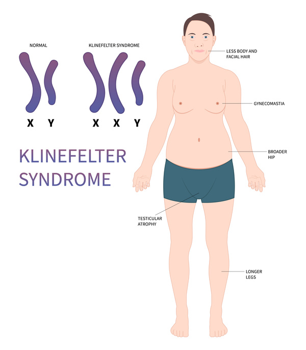 クラインフェルター症候群の特徴