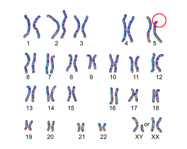 5p欠失症候群の染色体、猫鳴き症候群の染色体