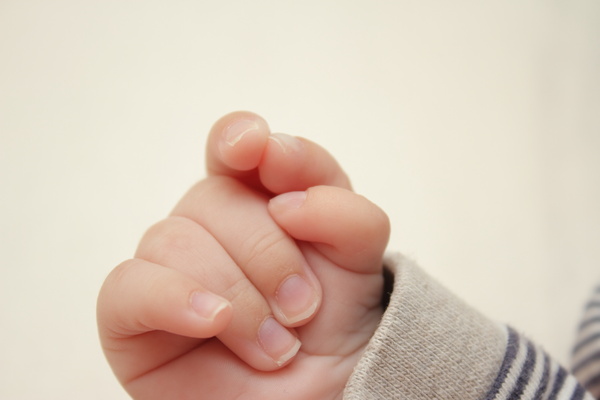 13トリソミーの赤ちゃんの手指の重なり、多指