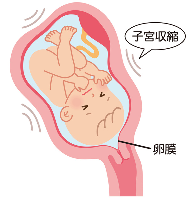 切迫早産の子宮内の赤ちゃん