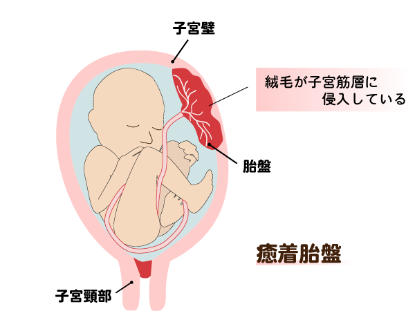 胎盤 胎盤の娩出と視診