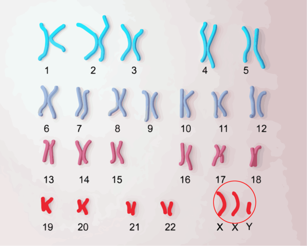 クラインフェルター症候群の染色体、染色体が多い