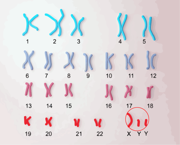 XYY症候群の染色体、染色体が多い