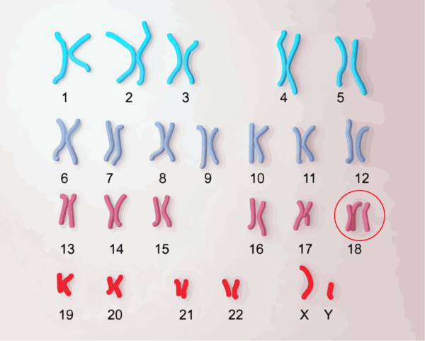 18トリソミーの染色体、染色体が3本になっている