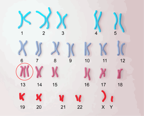 13トリソミーの染色体、染色体が3本になっている
