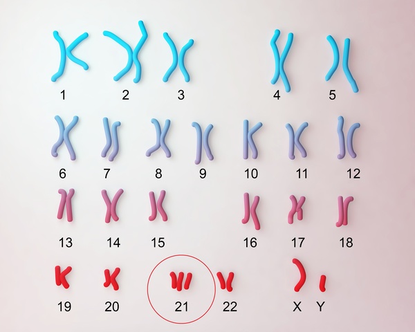 21トリソミーの染色体、染色体が3本になっている