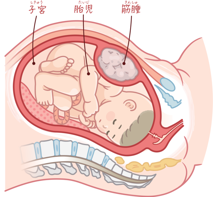 筋腫合併妊娠のイラスト、子宮筋腫