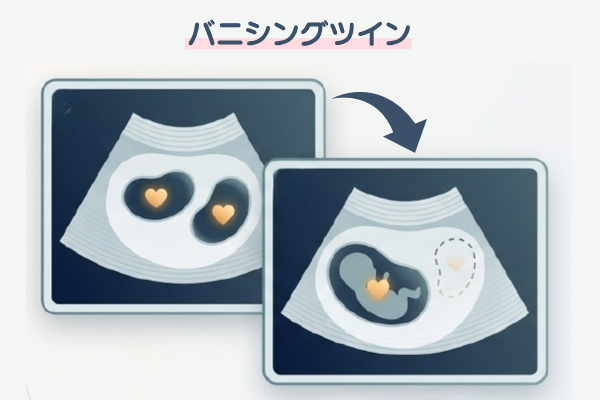 バニシングツイン